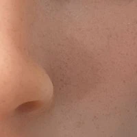 Facial Freckles